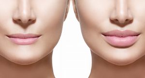 Leia mais sobre o artigo Contorno e aumento dos lábios com PREENCHIMENTO LABIAL