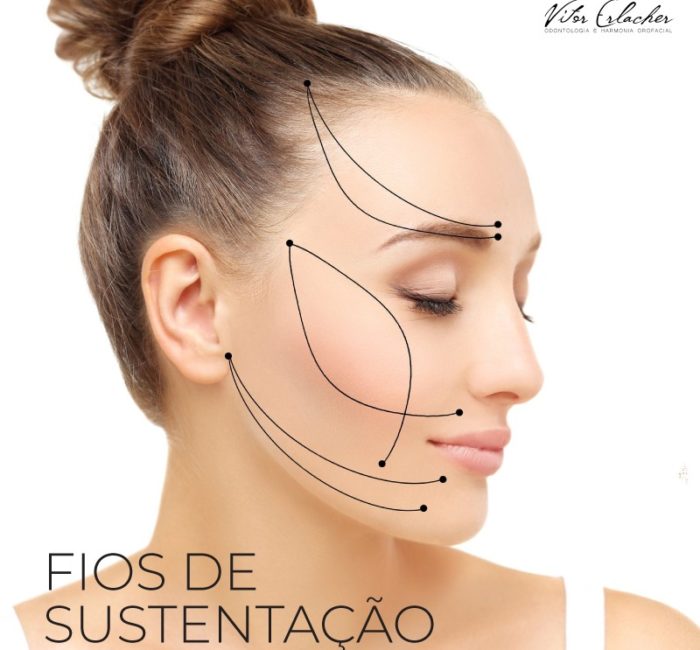 Rejuvenescimento facial com Fios de Sustentação