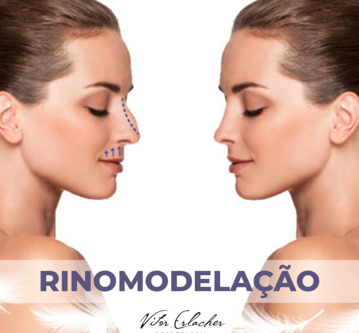 Rinomodelação: O que é? Como funciona? Dói?