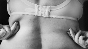 Leia mais sobre o artigo Intradermoterapia: o procedimento que reduz a gordura corporal