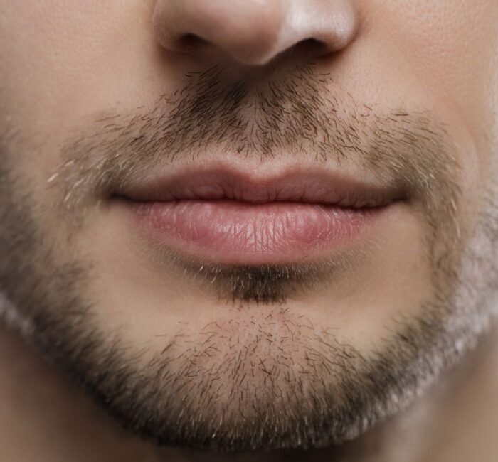 Preenchimento de mandíbula masculina: tenha um contorno facial mais definido e forte